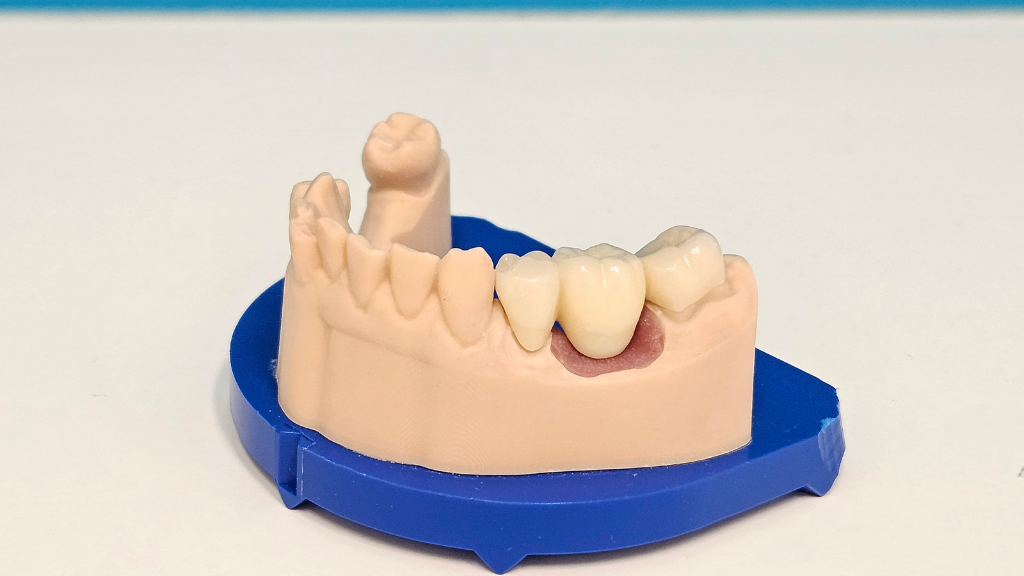 Guide to Dental Bridges