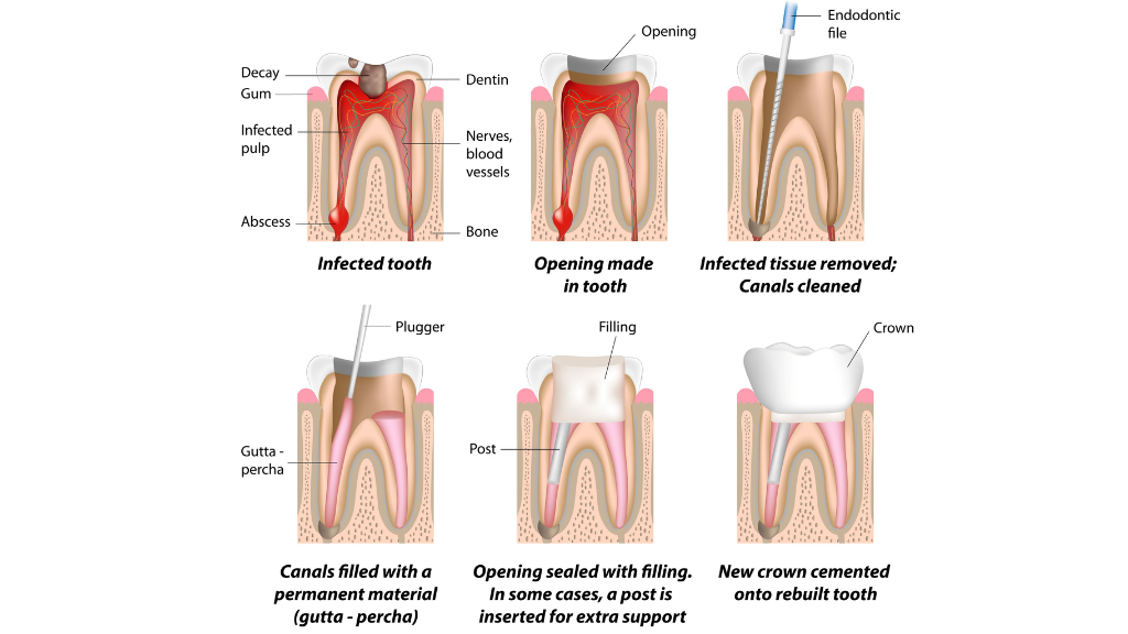 What is Root Canal Treatment?